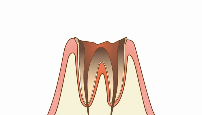 C4：歯質が失われた虫歯